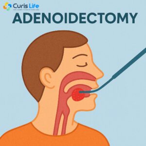 Adenoidectomy_Ent_in_Andheri_West_at_Curis_Life