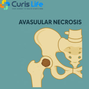 Avascular_Necrosis_Treatment_in_Andheri_West_at_Curis_Life
