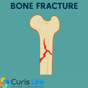 Bone_Fracture_Treatment_in_Andheri_West_at_Curis_Life