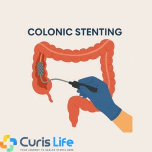 Colonic_Stenting_Andheri_West_Curis_Life