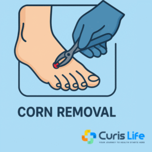 Corn_Removal_Curis_Life_ Andheri West