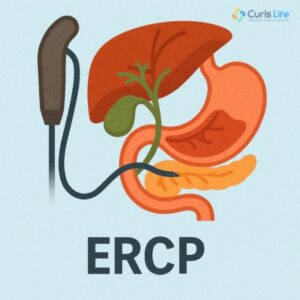 ERCP_Endoscopic_Retrograde_Cholangiopancreatography_in_Andheri_West_at_Curis_Life