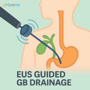 EUS_Guided_GB_Drainage_in_Andheri_West_at_Curis_Life