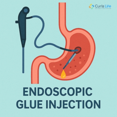 Endoscopic Glue Injection in Andheri West | Curis Life