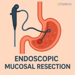 Endoscopic_Mucosal_Resection_in_Andheri_West_at_Curis_Life