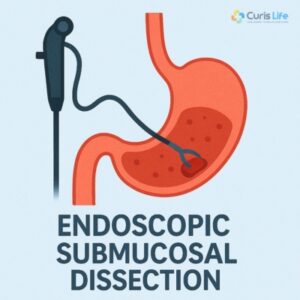 Endoscopic_Submucosal_Dissection_in_Andheri_West_at_Curis_Life
