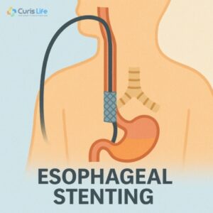 Esophageal_Stenting_in_Andheri_West_at_Curis_Life