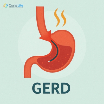 GERD_in_Andheri_West_Curis_Life