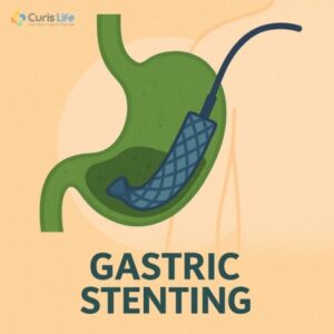 Gastric_Stenting_in_Andheri_West_at_Curis_Life