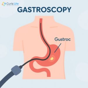 Gastroscopy_in_Andheri_West_at_Curis_Life