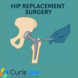 Hip_Replacement_Surgery_in_Andheri_West_at_Curis_Life