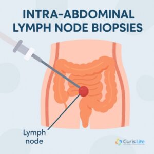 Intra-abdominal_Lymph_Node_Biopsies_in_Andheri_West_at_Curis_Life