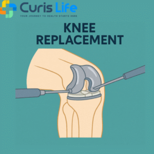 Knee_Replacement_Surgery_in_Andheri_West_at_Curis_Life