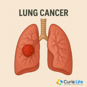 Lung_Cancer_Treatment_Curis_Life_Andheri_West