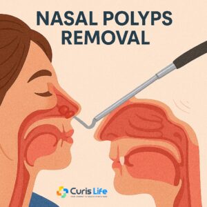 Nasal_Polyps_Removal_Ent_in_Andheri_West_at_Curis_Life