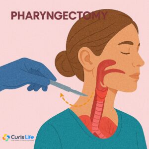 Pharyngectomy_Ent_in_Andheri_West_at_Curis_Life