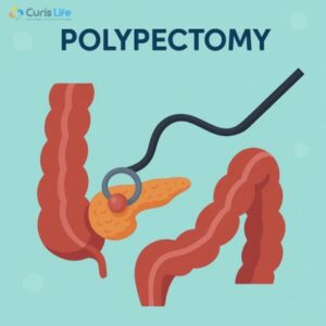 Polypectomy_in_Andheri_West_Curis_Life