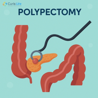 Polypectomy in Andheri West | Curis Life