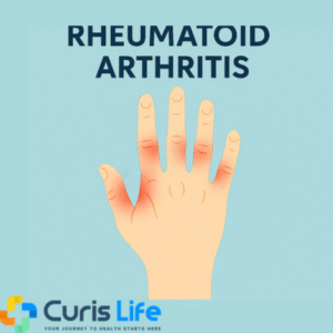 Rheumatoid_Arthritis_Treatment_in_Andheri_West_at_Curis_Life (1)