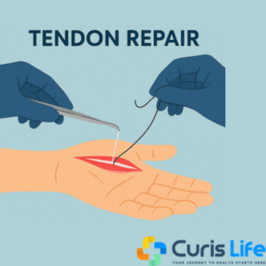 Tendon_Repair_Surgery_in_Andheri_West_at_Curis_Life