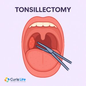 Tonsillectomy_Ent_in_Andheri_West_at_Curis_Life