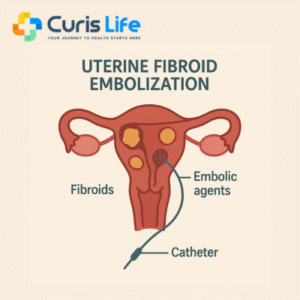 uterine-fibroid-embolization-ufe-andheri-west-curis-life