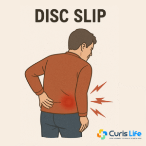 Slipped_Disc_Treatment_Andheri_West_Curis_Life