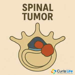 Spinal_Tumor_Treatment_Andheri_West_Curis_Life