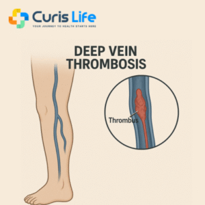 deep-vein-thrombosis-dvt-treatment-andheri-west-curis-life