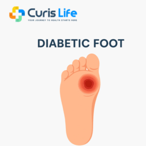diabetic-foot-treatment-andheri-west-curis-life
